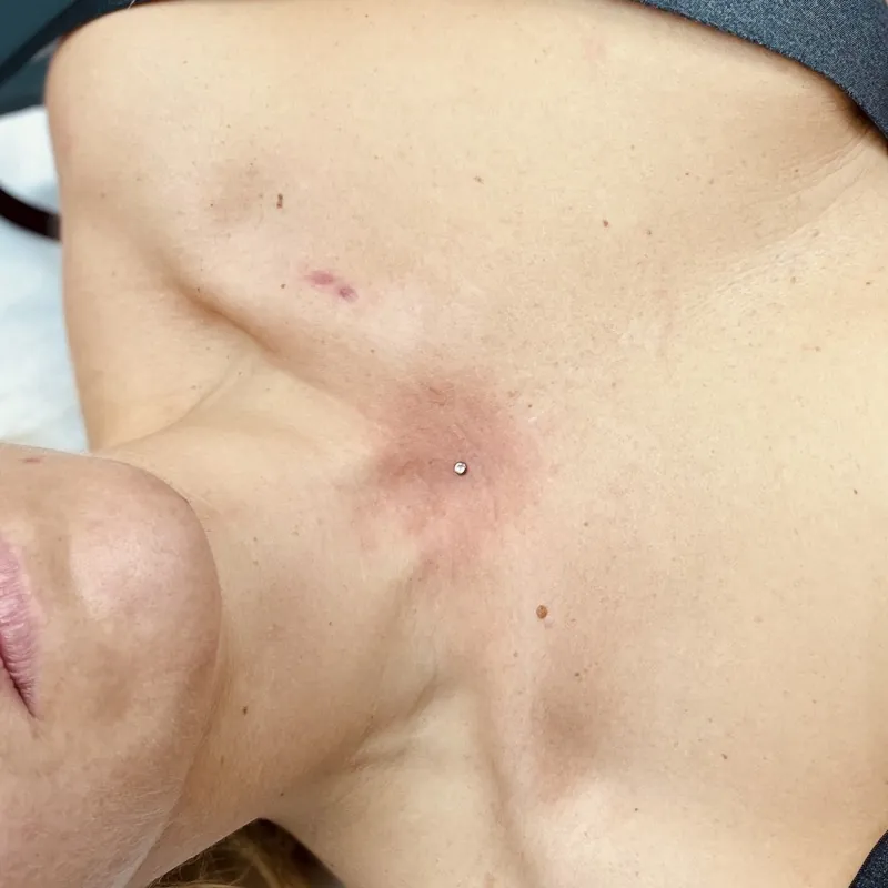 Microdermal piercing ve Viper Studiu