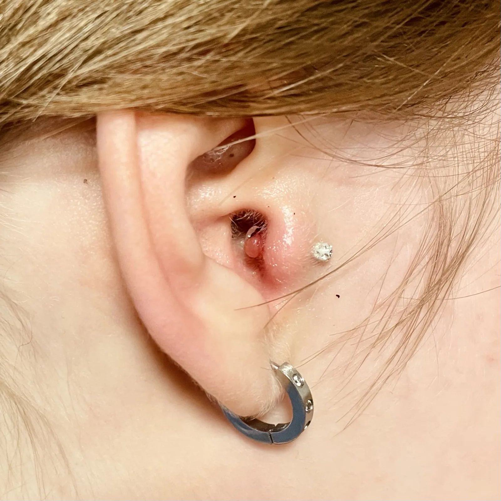 Konzultace problematického piercingu