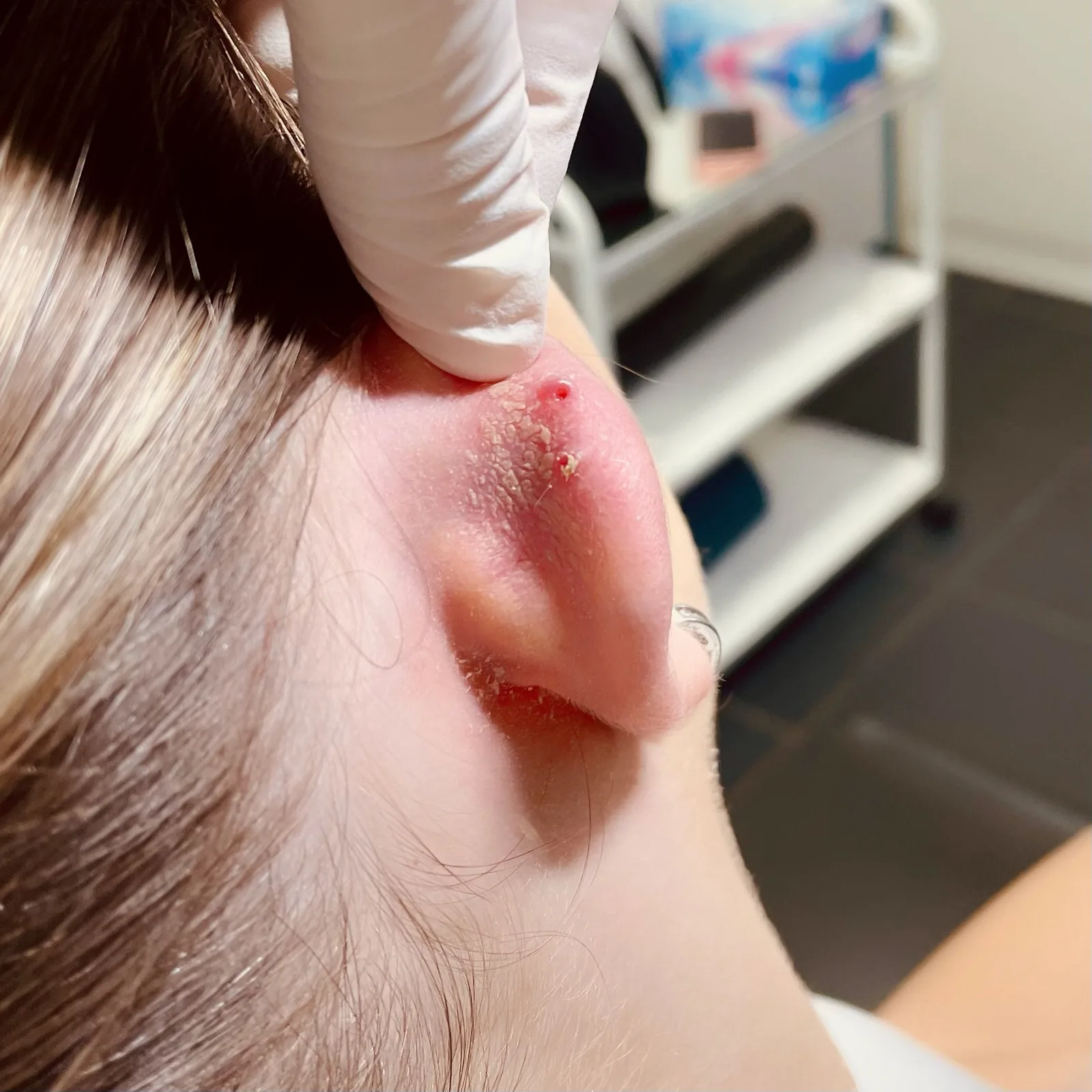 Řešení komplikací s piercingem — Viper Studio