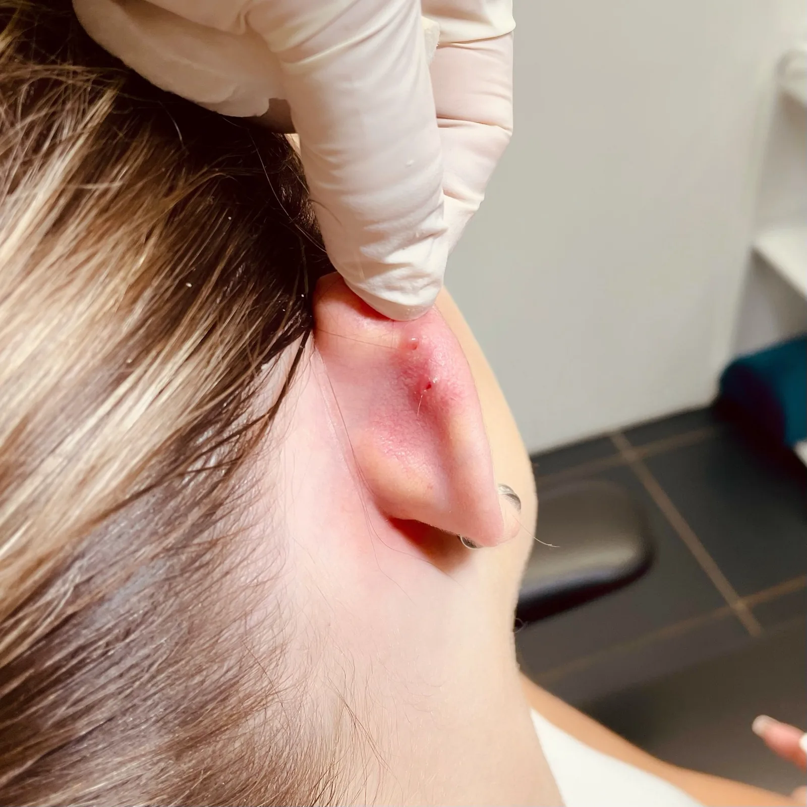 Konzultace problematického piercingu